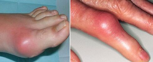 Εμφάνιση αρθρώσεων με αρθρίτιδα